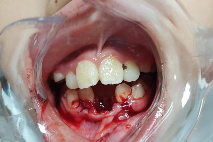 正畸导致牙齿脱落，原因究竟出在哪？-图1