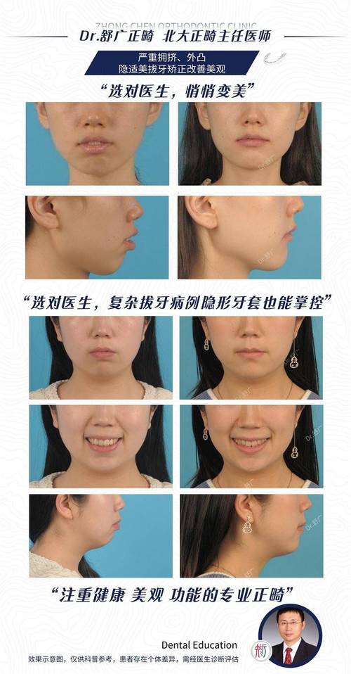 正畸拔牙影响脸型-图3 正畸拔牙影响脸型-图3