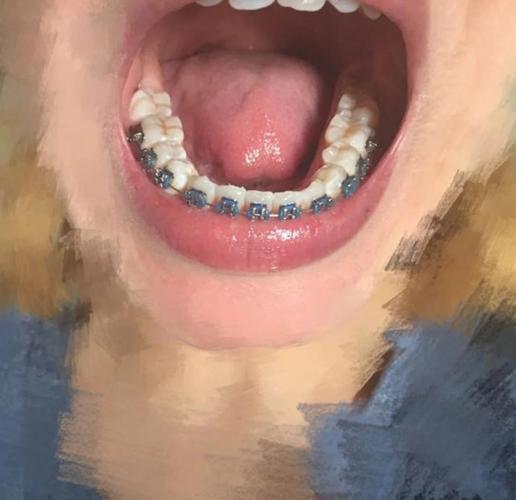 正畸橡皮链为什么会染色?会影响矫正效果吗?-图3 正畸橡皮链为什么会染色?会影响矫正效果吗?-图3