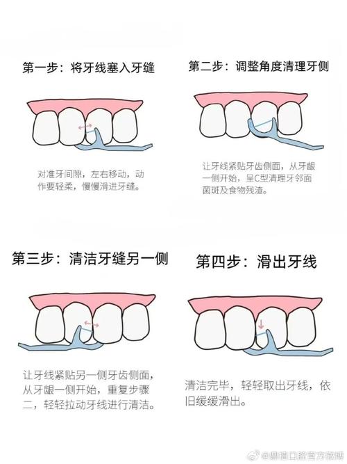 正畸如何使用牙线-图1