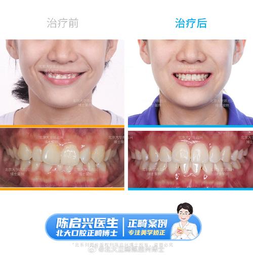 北大医院牙齿正畸-图3