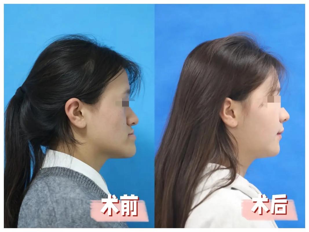 正畸后能不能正颌-图2