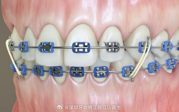 正畸橡皮筋有何用？多久换要注意啥？-图2