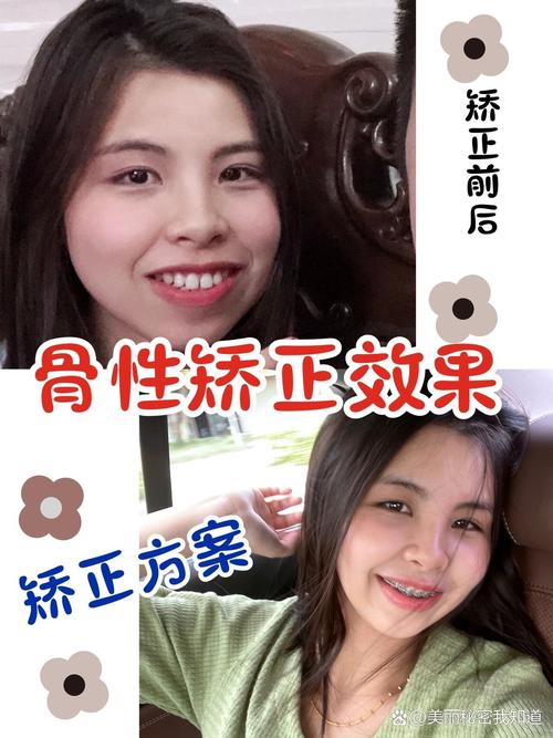 骨性正畸效果究竟如何?真实疗效深度解析-图2 骨性正畸效果究竟如何?真实疗效深度解析-图2