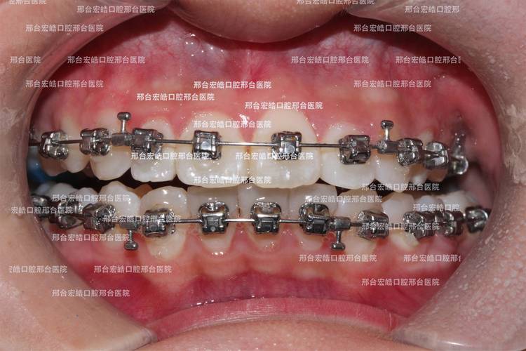 骨性正畸效果究竟如何?真实疗效深度解析-图3 骨性正畸效果究竟如何?真实疗效深度解析-图3