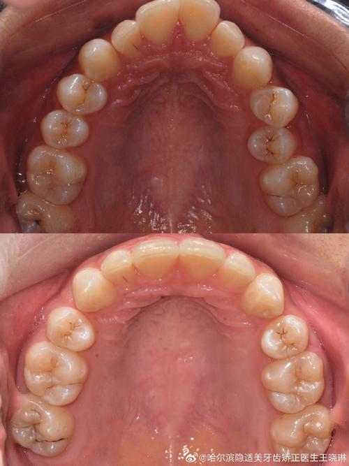 正畸 第一双尖牙-图1