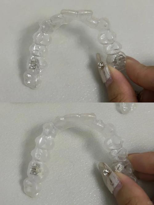 妃她隐形牙套正畸效果如何？舒适度够好吗？-图2