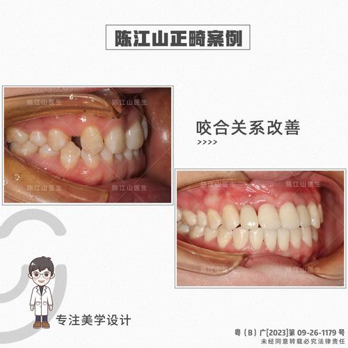 髁突吸收能正畸吗？治疗风险与效果如何评估？-图2