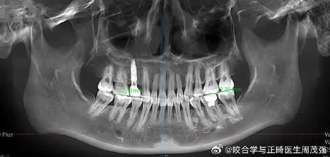 髁突吸收能正畸吗？治疗风险与效果如何评估？-图3