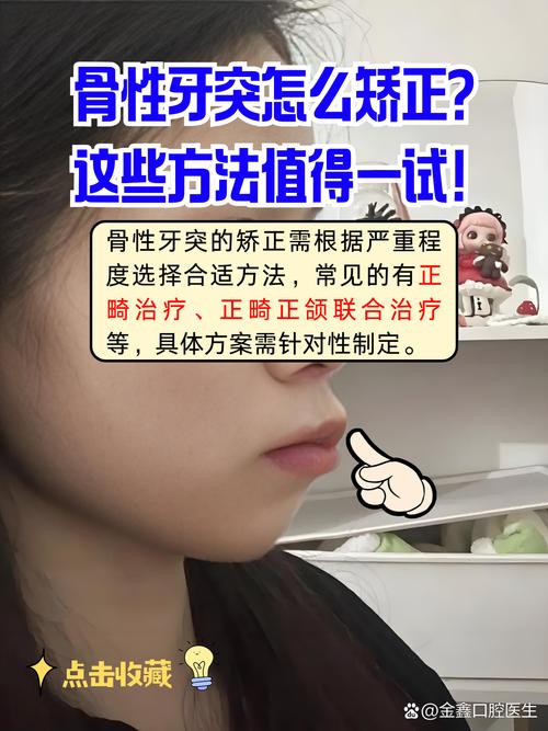 骨性龅牙如何正畸-图2