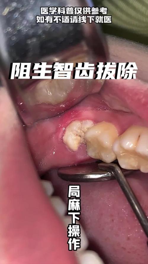 正畸为何要拔智齿？必须拔吗？-图3