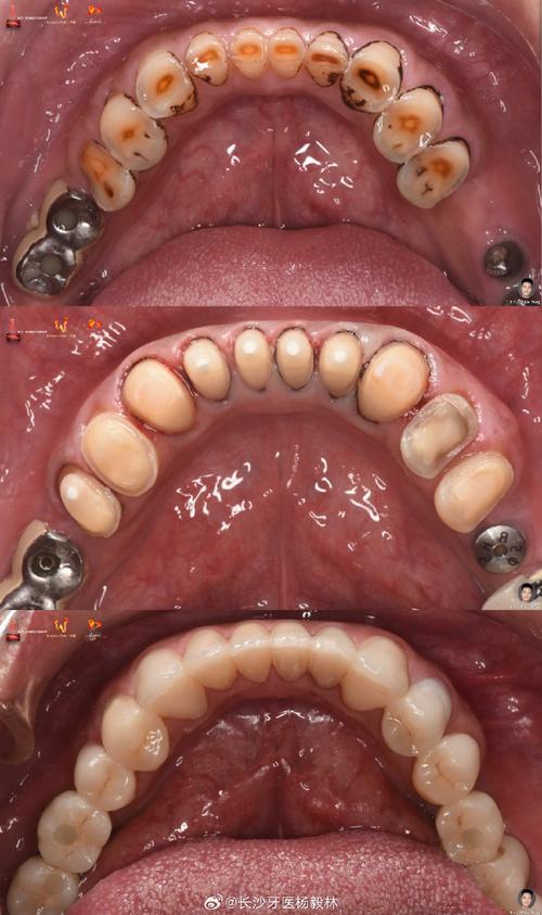 牙齿正畸为何需外科手术?效果与风险如何?-图1 牙齿正畸为何需外科手术?效果与风险如何?-图1