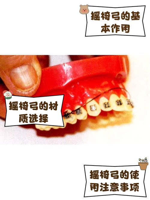 正畸摇椅弓副作用-图2 正畸摇椅弓副作用-图2