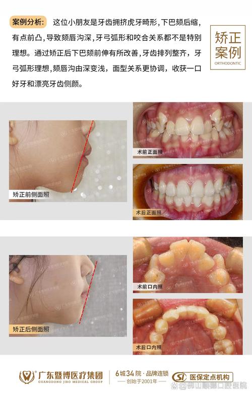 牙齿稀疏正畸案例-图2 牙齿稀疏正畸案例-图2
