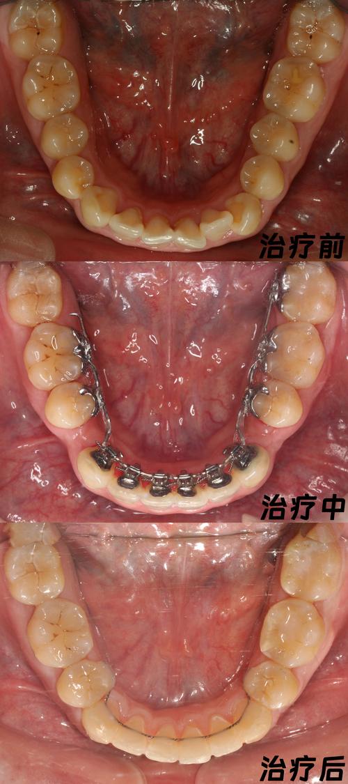 最新牙齿正畸手术-图2