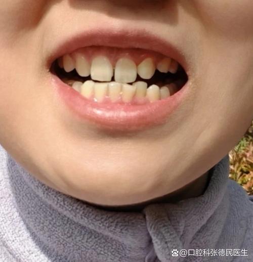 正畸期间牙缝变大-图1