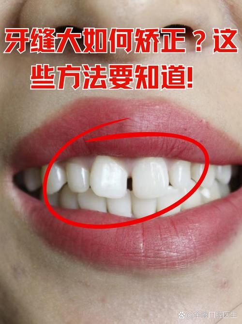 正畸期间牙缝变大-图3