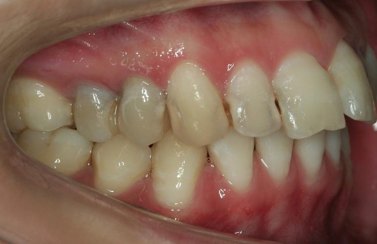 正畸期间睡觉磨牙-图2