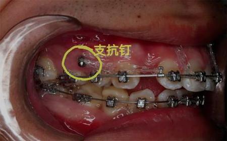 正畸拔牙排开牙齿-图1
