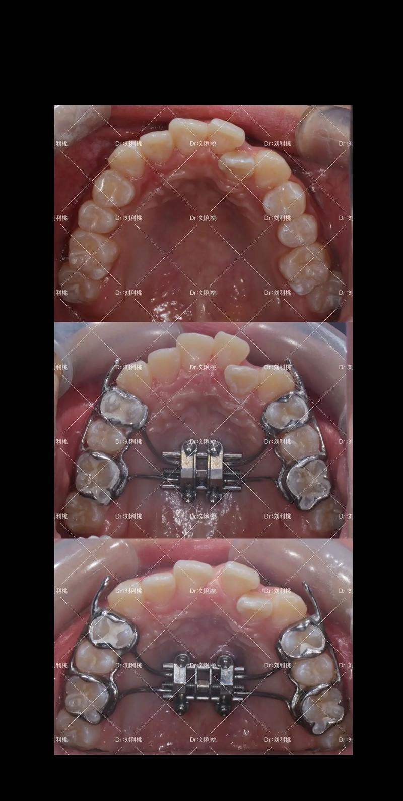 正畸mbt弓形图-图2