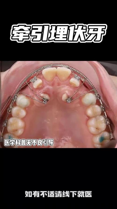 正畸垂直牵引图片-图1 正畸垂直牵引图片-图1