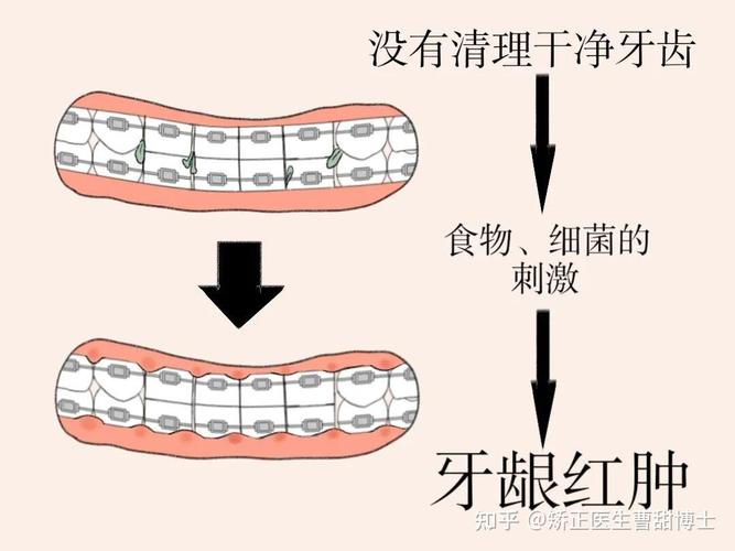 正畸中可以洗牙吗？-图2