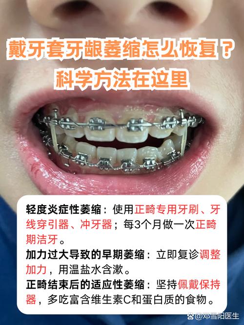 牙龈萎缩能正畸吗-图3 牙龈萎缩能正畸吗-图3