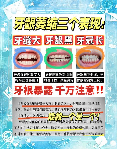 牙龈萎缩能正畸吗-图2 牙龈萎缩能正畸吗-图2