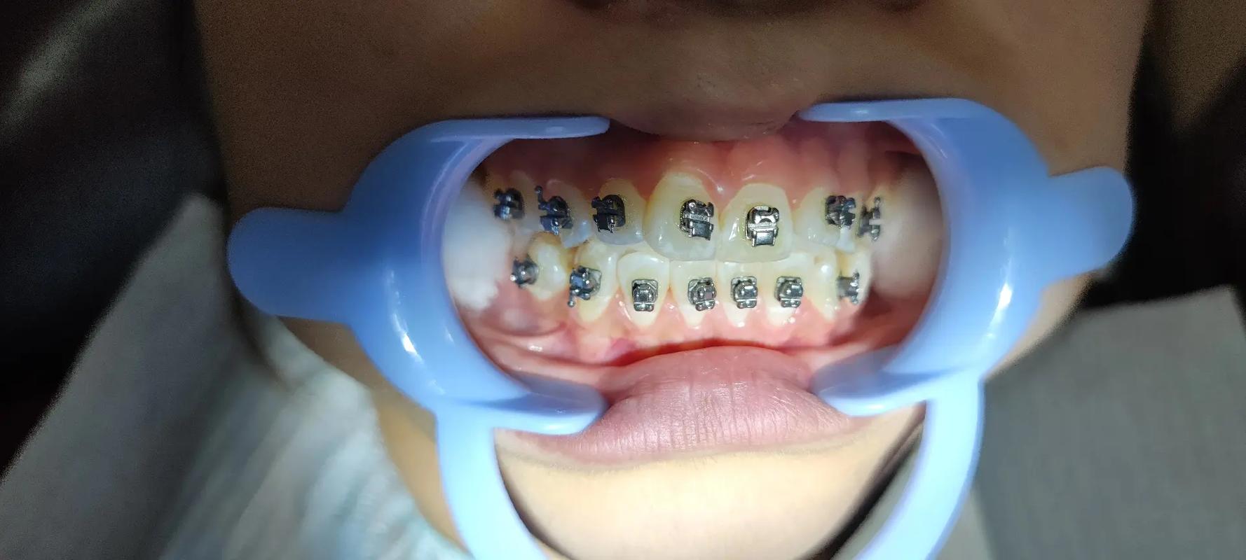 自锁托槽正畸技术-图3