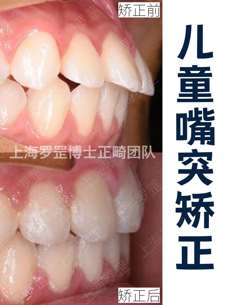 上海正畸要多少钱-图2
