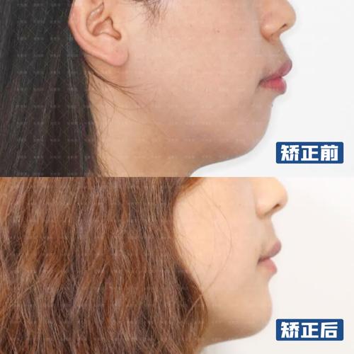 正畸矫正下巴后缩-图2