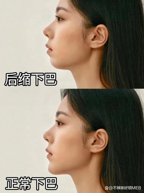 正畸矫正下巴后缩-图3