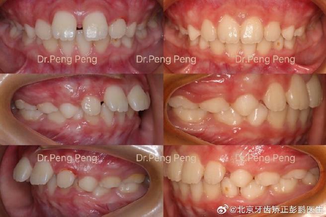前牙深覆盖 正畸-图2