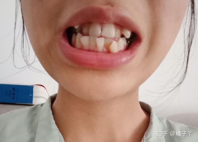 18岁 牙齿正畸-图3