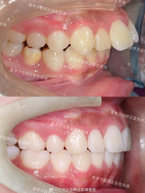 龅牙不拔牙正畸可行吗?效果怎么样?-图2 龅牙不拔牙正畸可行吗?效果怎么样?-图2