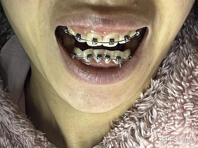 成都牙齿正畸医院怎么选?效果、费用、医生要注意啥?-图1 成都牙齿正畸医院怎么选?效果、费用、医生要注意啥?-图1