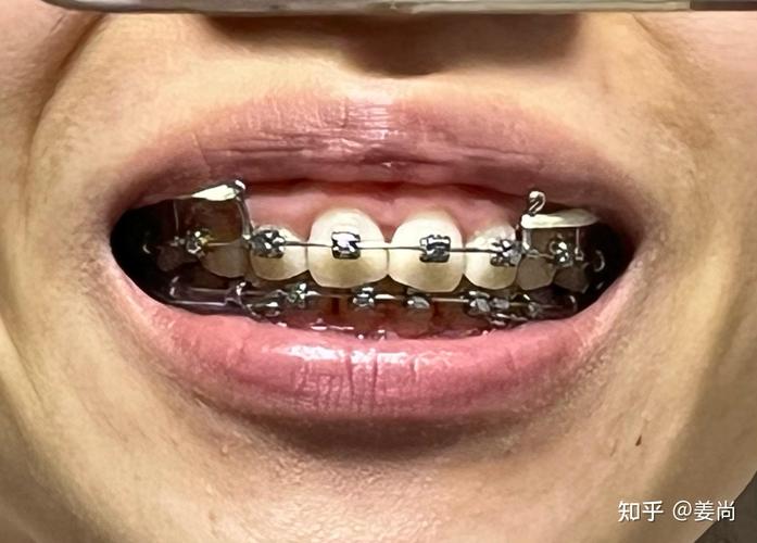 成都牙齿正畸医院怎么选?效果、费用、医生要注意啥?-图2 成都牙齿正畸医院怎么选?效果、费用、医生要注意啥?-图2