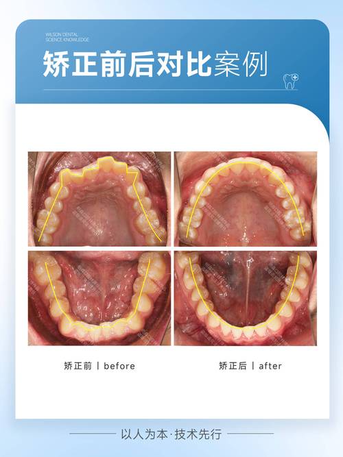 正畸调整咬合，究竟对牙齿功能有何关键作用？-图2