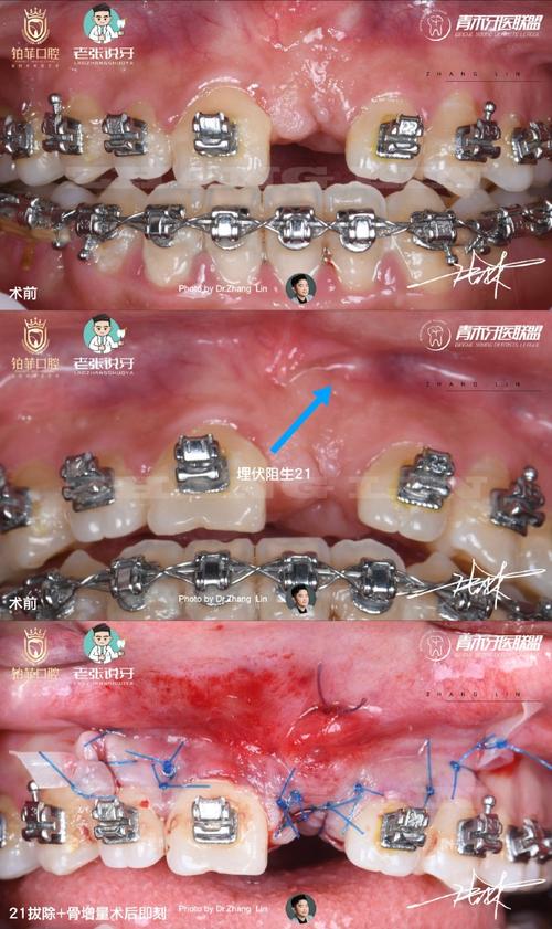 牙齿正畸前要手术-图2