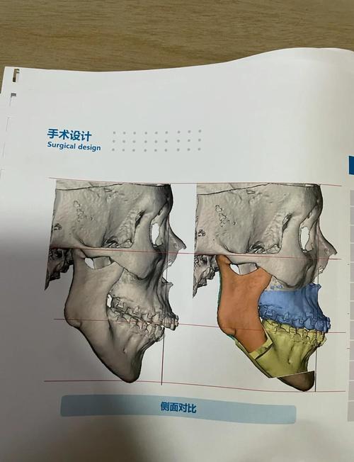 正畸后为何还需正颌手术?两者如何协同作用?-图1 正畸后为何还需正颌手术?两者如何协同作用?-图1