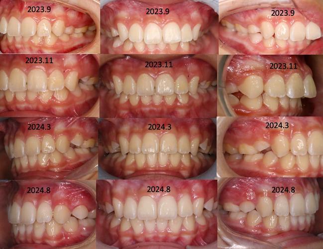 3d数码隐形正畸-图2