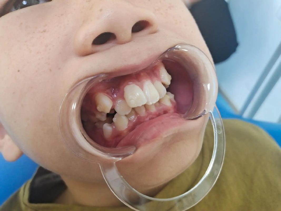 北京 正畸 隐形-图3 北京 正畸 隐形-图3