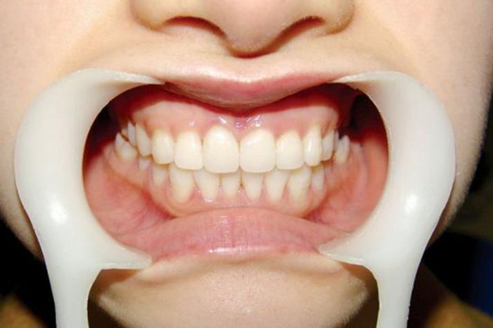 牙周炎治疗后正畸-图1