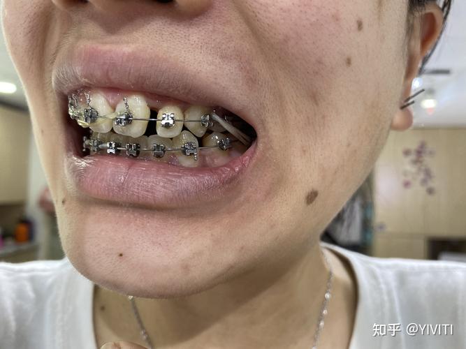 上海专家牙齿正畸-图1