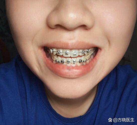 正畸之后咬合不好-图2