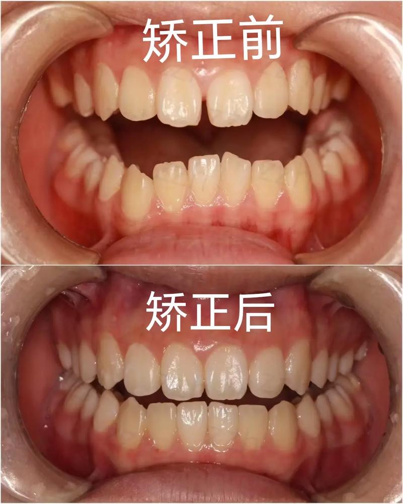 正畸后脸型变化图-图1