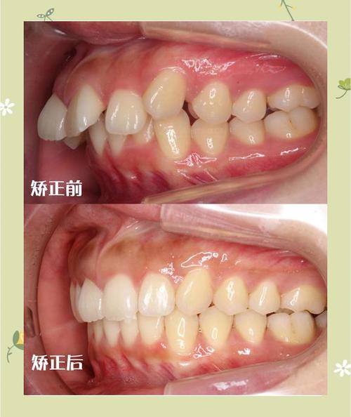 正畸后脸型变化图-图2