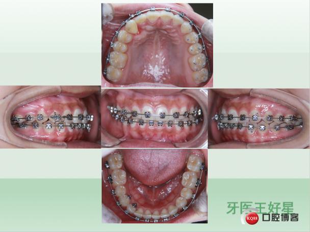 第一篇正畸博客-图2