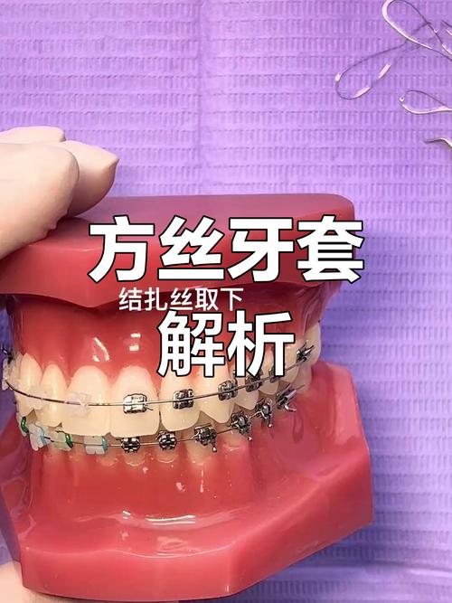 正畸弓丝往一侧-图2 正畸弓丝往一侧-图2