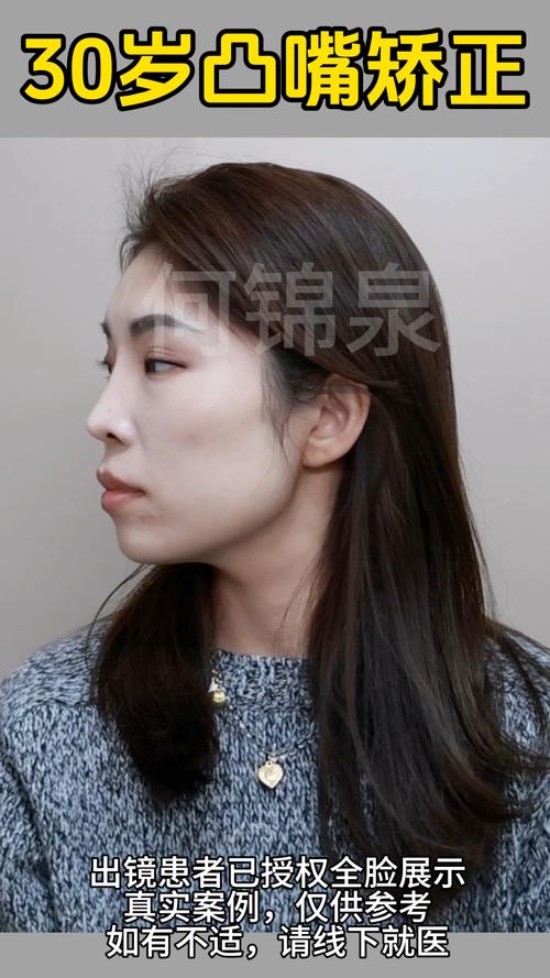 正畸后嘴会变皱-图2